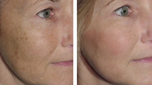 Photofacials and Rosacea treatment in Burnaby BC.