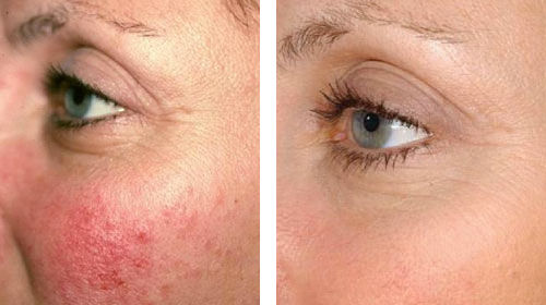 Rosacea treatment in Burnaby BC.