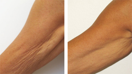 Rosacea, Skin Tightening in Burnaby BC.