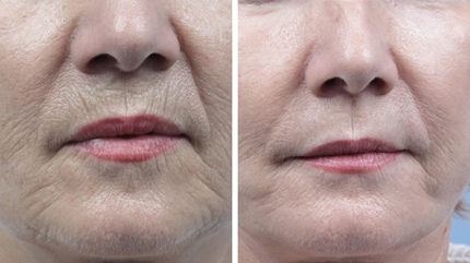 Skin Tightening in Vancouver BC.