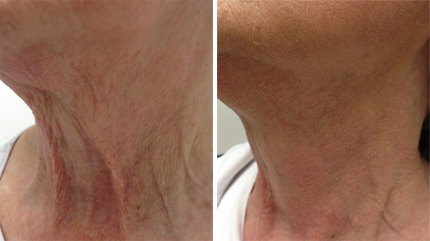 Skin Tightening, photofacials in Vancouver BC.