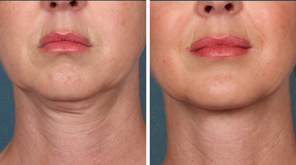 Skin Tightening in Burnaby BC.