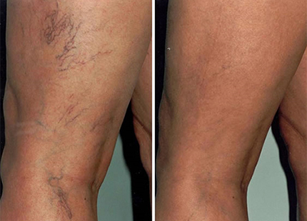 Leg Vessels and Vains in Burnaby BC