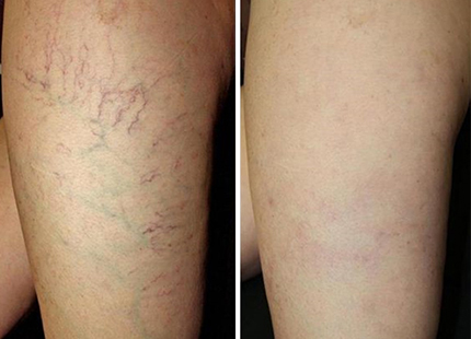 Leg Vessels and Vains in Vancouver BC