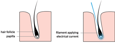 Electrolysis in Burnaby BC.